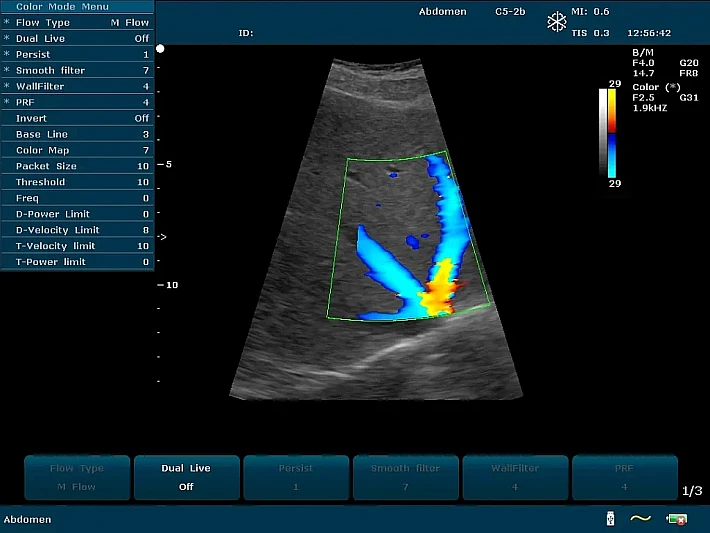 U2PE C5-2b Liver ascites (5)_result