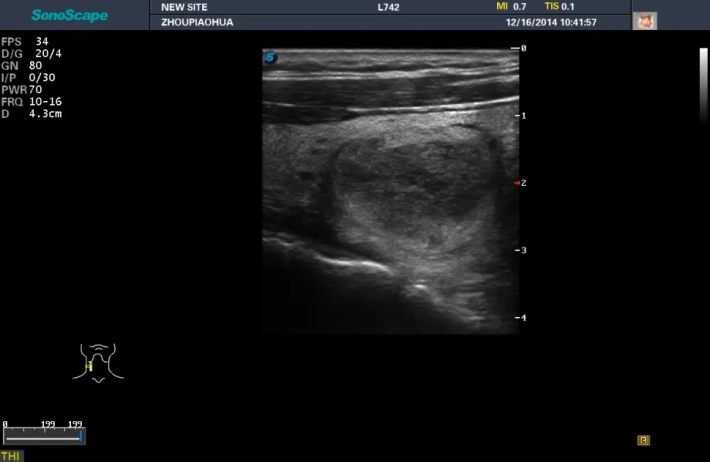 1. Thyroid Adenoma_result