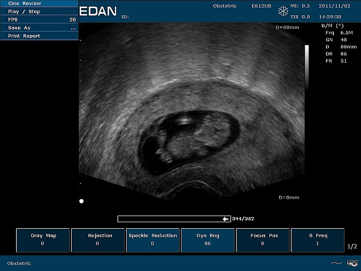 U50PE Transvaginal Scan of Fetus (1)