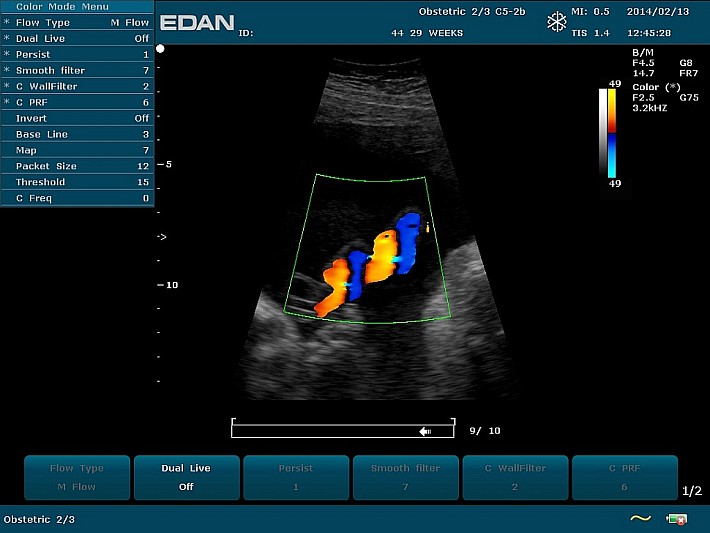 U50PE C352UB Fetus  Umbilical cord blood flow(2)