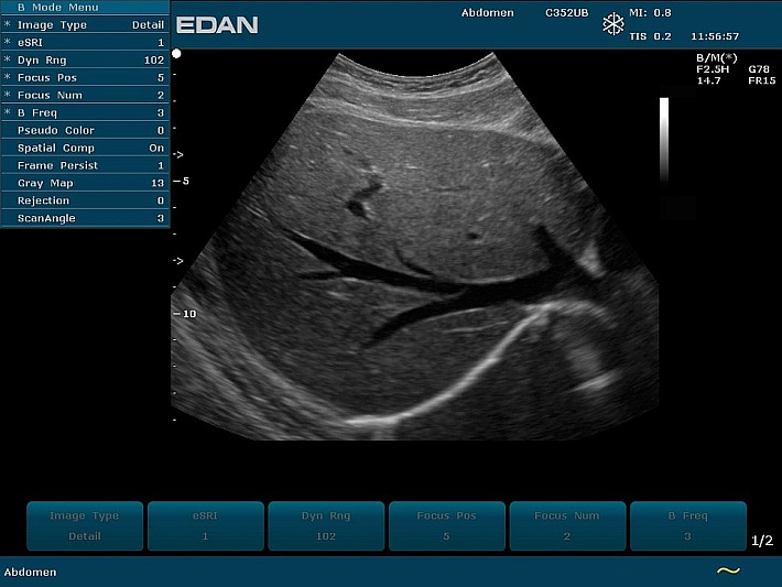 U50PE C352UB Abd Liver CDI med  (1)