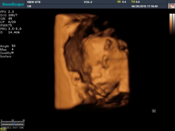 1. Лицо плода_result