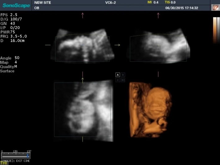 2. Лицо плода_result