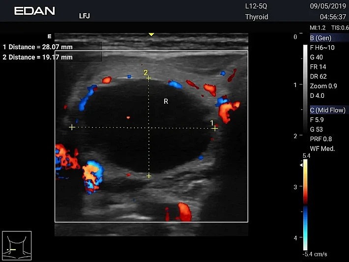 AX3 12-5Q Thyroid (3)_result