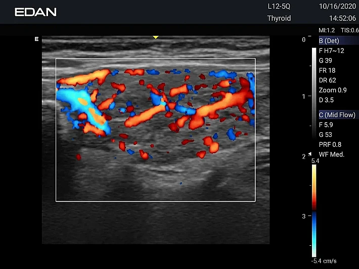 AX3 12-5Q Thyroid (1)_result