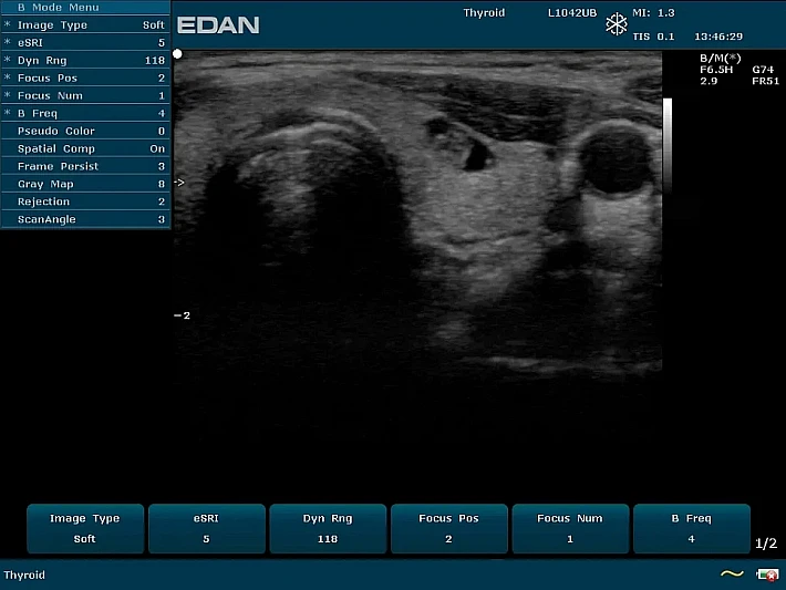 U50PE L1042UB Thyriod_result