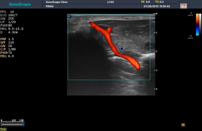 3. Palmar Arcuate Artery_color_result