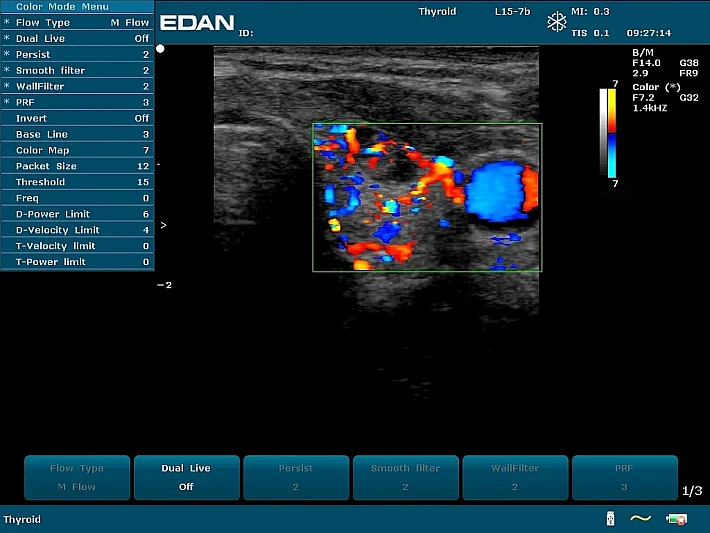 U50 PE L15-7b Colour Thyroid_result