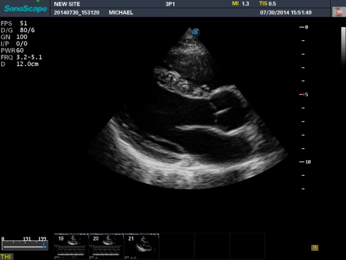 4. ЛЖ длинная ось_result