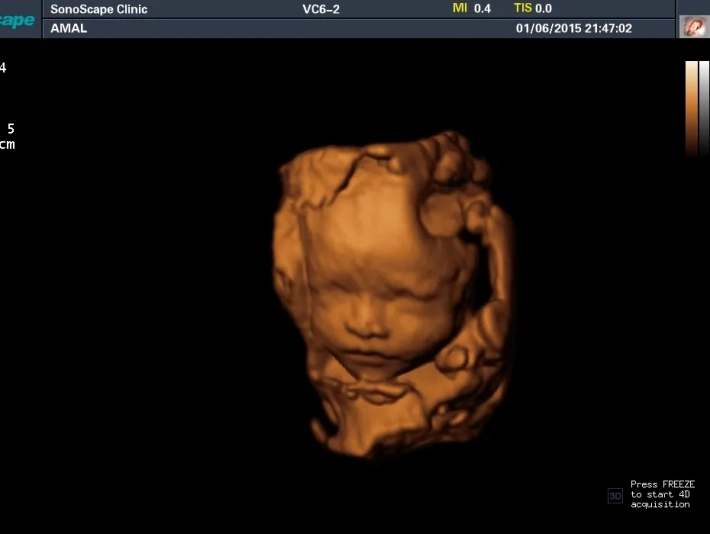 2. Лицо плода_3D_result