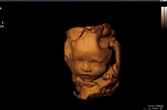 2. Лицо плода_3D_result