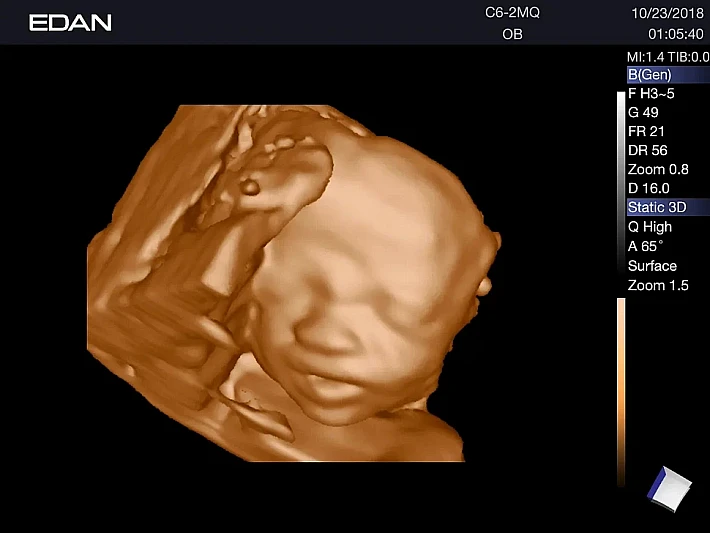 AX3 C5-2Q Fetus (1)_result