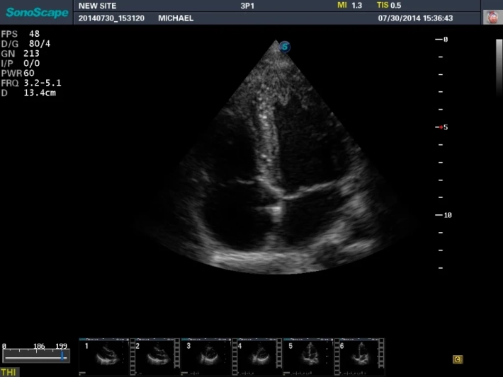 6. Апикальная четырехкамерная позиция_result