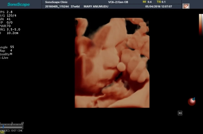 2. Лицо плода_S-Live_result