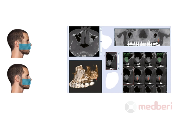 Стоматологический томограф NewTom 2D/3D Go