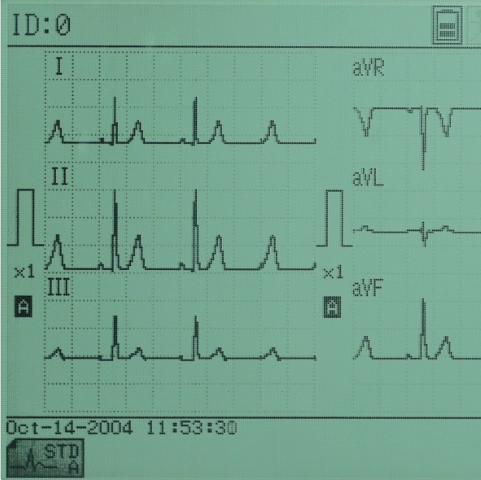Электрокардиограф FX-7102